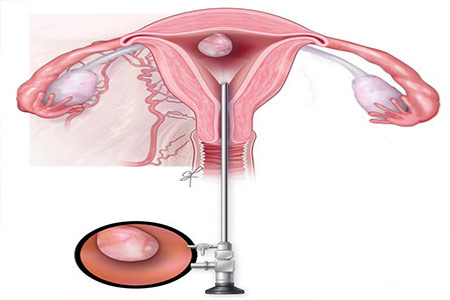 Hysteroscopy